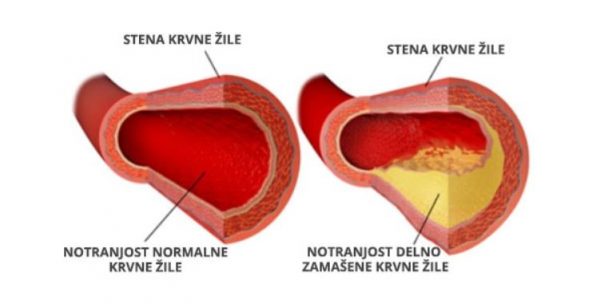 holesterol in krvne žile
